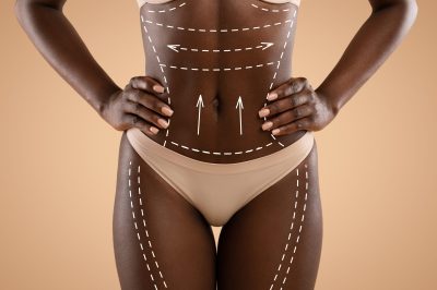 Lower body lifts concept. Cropped of african american woman in underwear with white pen marks over her body hips and belly posing on beige background before plastic surgery, collage